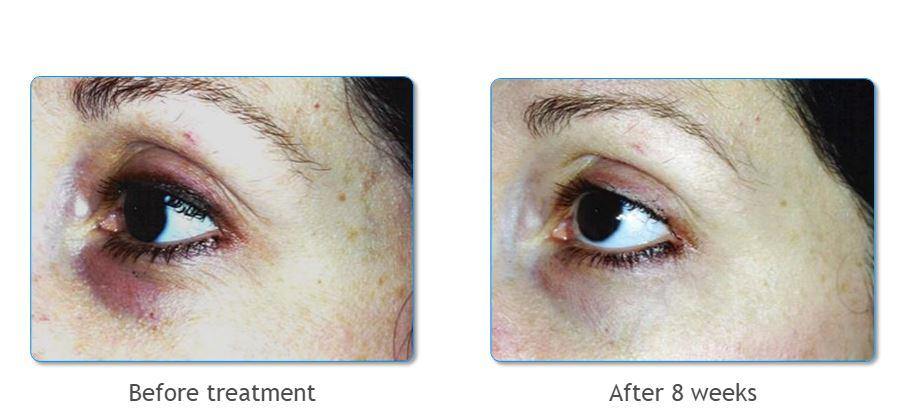 elaine perine lovely eyes 8weekseffekt 9c9cb1a5 8c11 4f47 8955 150e9f0ae274 1200x elaine perine lovely eyes 8weekseffekt 9c9cb1a5 8c11 4f47 8955 150e9f0ae274 1200x